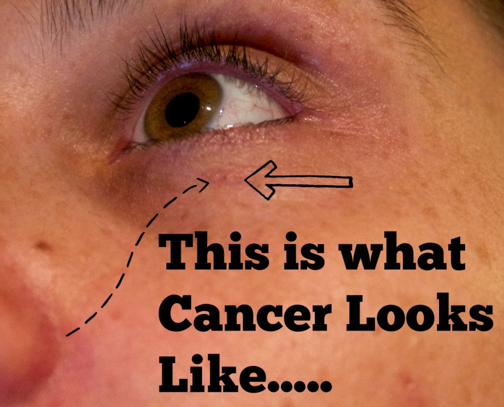 what does skin cancer look like-basal cancer